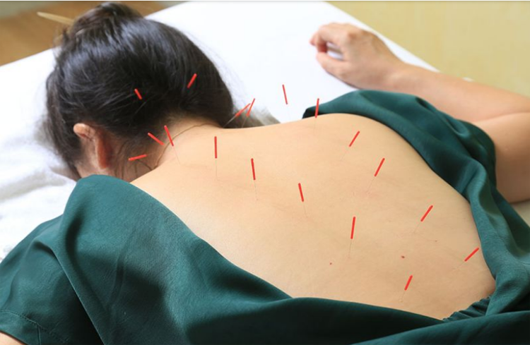 Điện mãng châm điều trị liệt tứ chi do chấn thương cột sống cổ (Nuy chứng, kính chứng)
